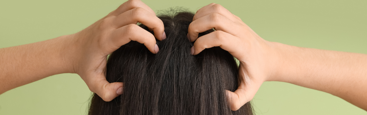 Kepekli Saçları Sağlıklı Hale Getirme Taktikleri